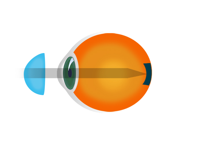 Hyperopia korrekció kontaktlencsékkel