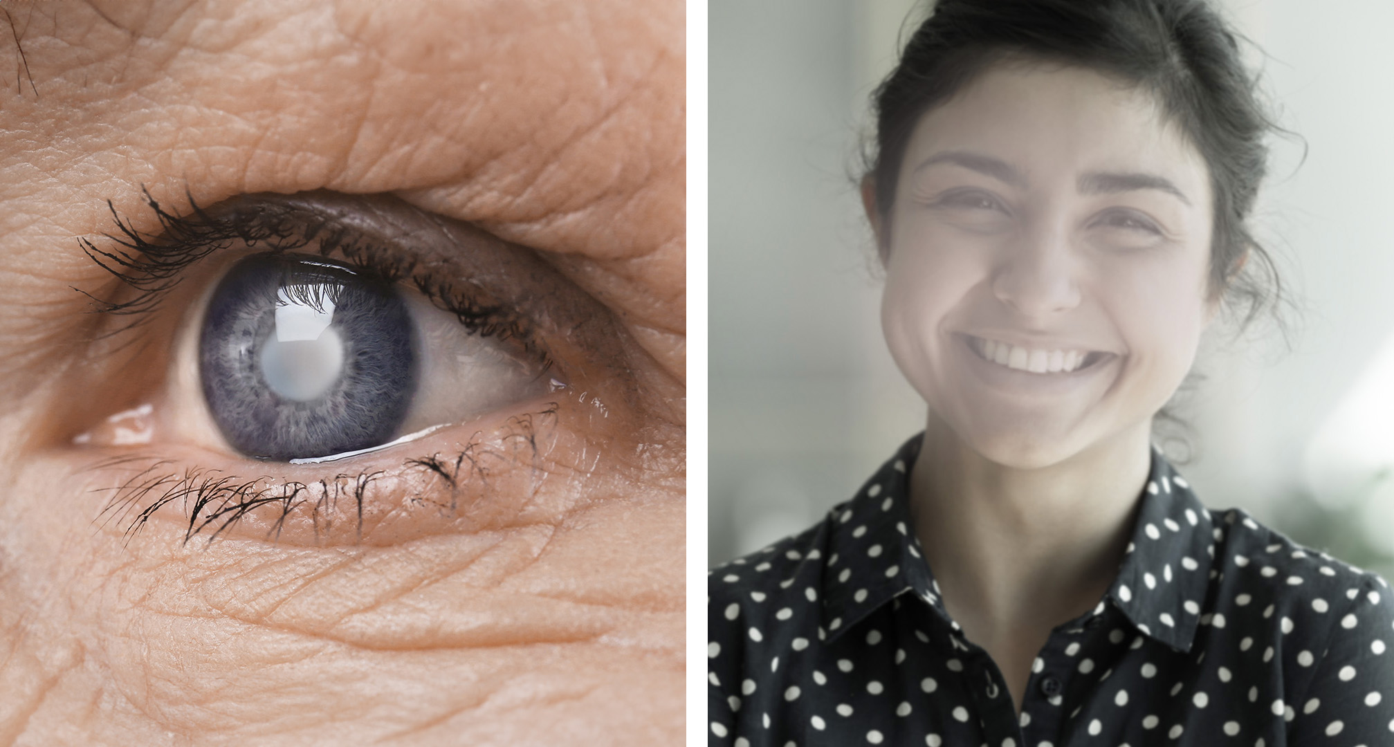 A szürkehályog fehér vagy homályos korongként jelenhet meg a lencsén (balra). Idővel homályos, tompa vagy ködös látáshoz vezethet (jobbra).