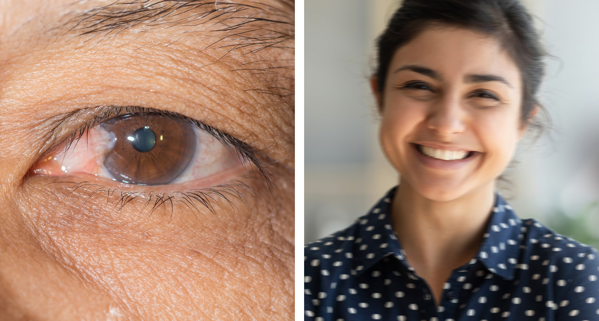 A pterygium a kötőhártya ék alakú növekedése, amely a szaruhártyára terjed (balra). Extrém esetekben, ha a pterygium a pupilla fölé terjed, akadályozhatja vagy elhomályosíthatja a látást (jobbra).